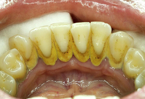 Làm thế nào để loại bỏ cao răng triệt để và an toàn?